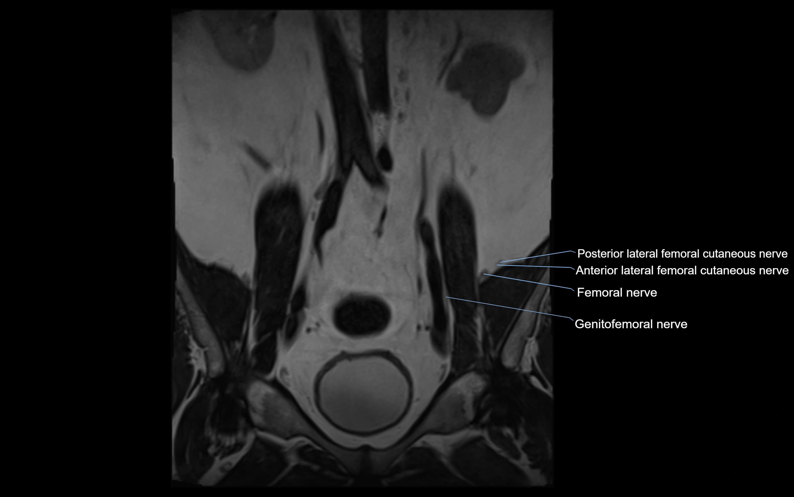 MR lumbosacral plexus cross sectional anatomy 3T  radiology  image-img-09001-00005.webp